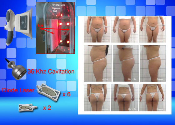 レーザー Lipo 装置の重量を凍らせている Cryo は家の美機械を失います